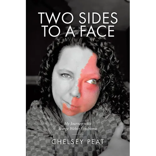 Two Sides to a Face: My Journey with Sturge Weber Syndrome